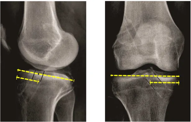 FIGURA  11.  Método  descrito  por  Amis  e  utilizado  por  Pinczewski  para  a  mensuração do túnel tibial