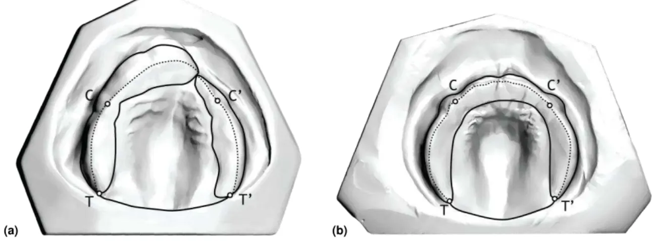 Figura 9 -  Modelo  digital  com  fissura  pré-forame  incisivo  unilateral  incompleta  (a)  e  com  fissura pré-forame incisivo bilateral incompleta (b),  nos quais foram marcadas as  distâncias intercaninos e intertuberosidades 