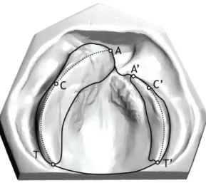 Figura 10-   Modelo  digital  com fissura  pré-forame incisivo  unilateral  completa,  no  qual foram  marcadas  as  distâncias  intercaninos,  intertuberosidades  e  do  afastamento  interrebordos na região anterior da fissura 
