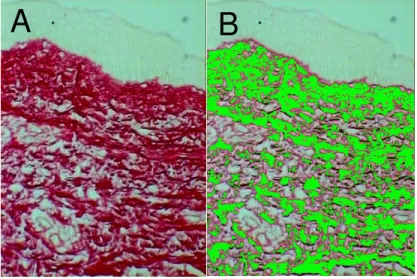 Figura 12 -   Corte histológico de pele pré-tratamento (caso 7). A. Fibras  colágenas  da derme  coradas  em  vermelho  pela coloração  de  Picrosirius  X340