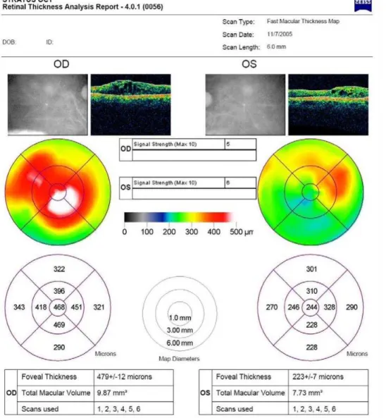 Figura 3. Mapa topográfico da superfície macular da retina dos olhos direito e  esquerdo 