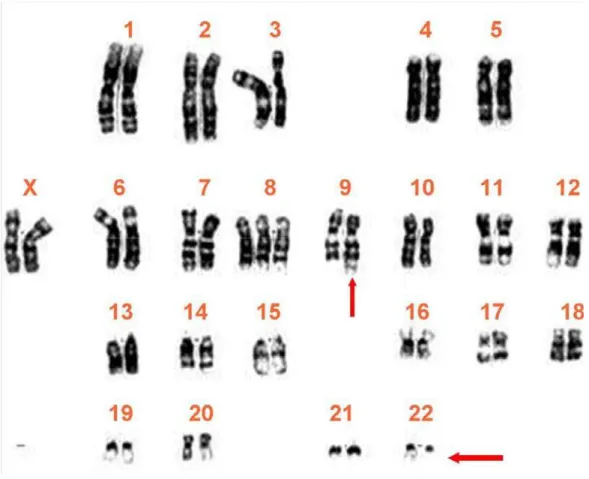Figura 1 – Cariótipo de um paciente com LMC positivo para cromossomo  Philadélphia. As setas representam os cromossomos híbridos resultantes  da translocação t(9;22)