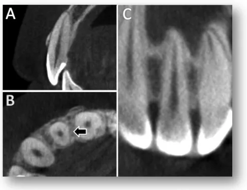 Figura 5.2 – Incisivo lateral superior com raiz  tipo I em cortes sagital (A), axial (B) e coronal (C) 