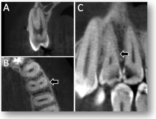 Figura 5.4 – Primeiro pré-molar superior com raiz  tipo IV em cortes sagital (A), axial (B) e coronal (C) 