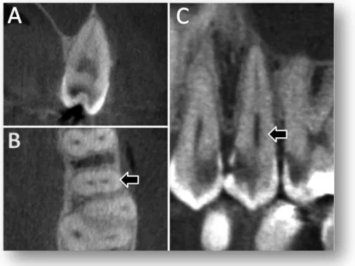 Figura 5.5 – Segundo pré-molar superior com raiz  tipo III em cortes sagital (A), axial (B) e coronal (C) 