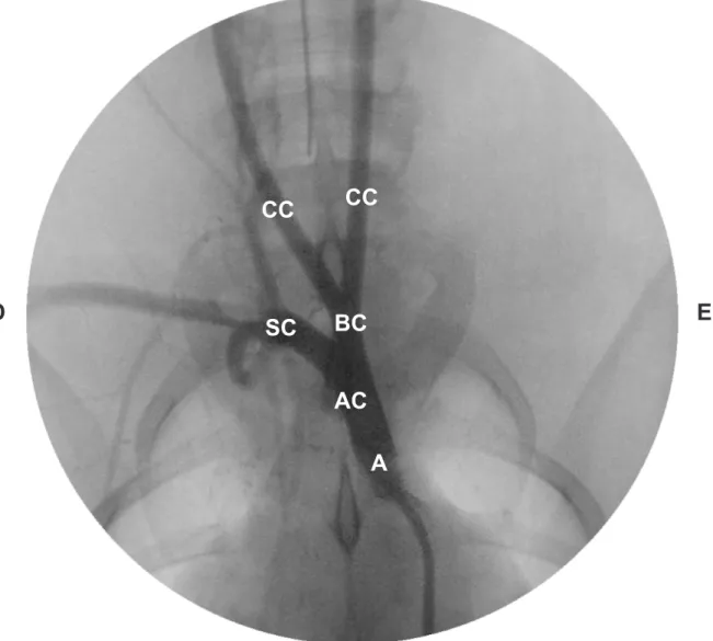 Figura 7 - Angiograia evidenciando a aorta (A), arco aortico (AC), tronco bicarotideo  (BC), artéria subclávia direita (SC) e artérias carótidas comum (CC)