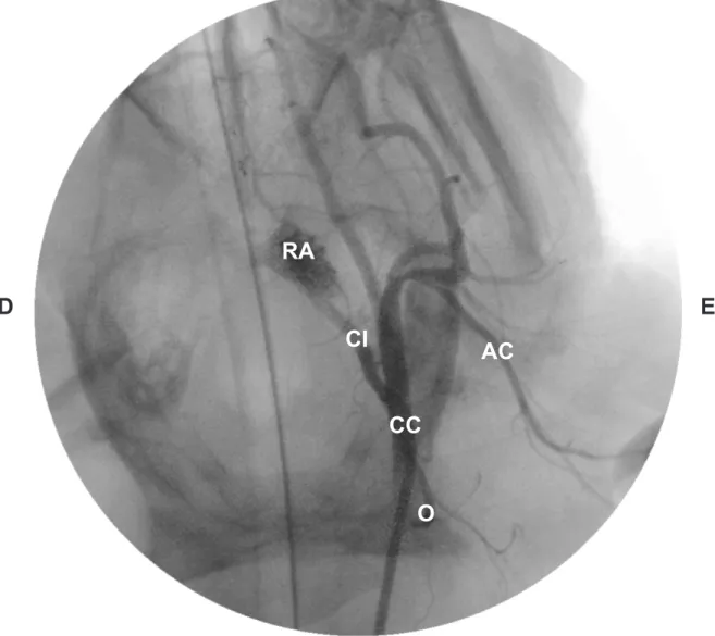 Figura 8 - Imagem  angiográica  evidenciando  a  ramiicação  da  artéria  carótida  comum (CC), artéria carótida interna (CI), rede admirável epidural rostral  (RA), artéria auricular caudal (AC) e artéria occipital (O)