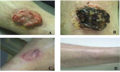 Figura 6 - Paciente do sexo masculino, 43 anos, apresentando um CBC (carcinoma basocelular) em perna direita
