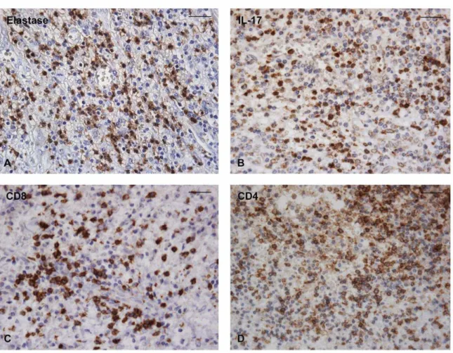 Figura 5.5 - Padrão de marcação imuno-histoquímica para elastase, IL-17, CD8 e CD4 para os casos  de granuloma periapical (Estreptavidina-biotina, aumento original de 400X, escala 50µm)