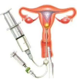 Figura 5. Injeção do Echovist   na cavidade uterina 