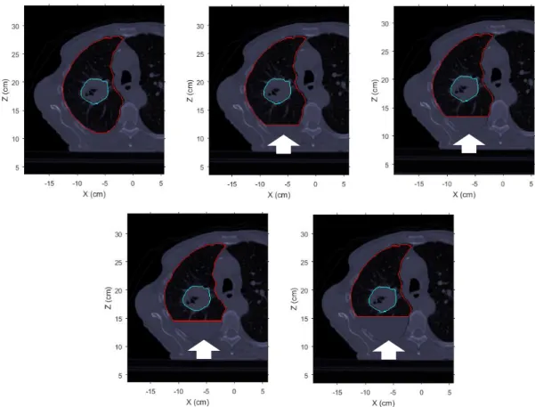 Figure 3.5 shows an example of simulated pleural effusion of different magnitudes inside the lung  which contains the tumor