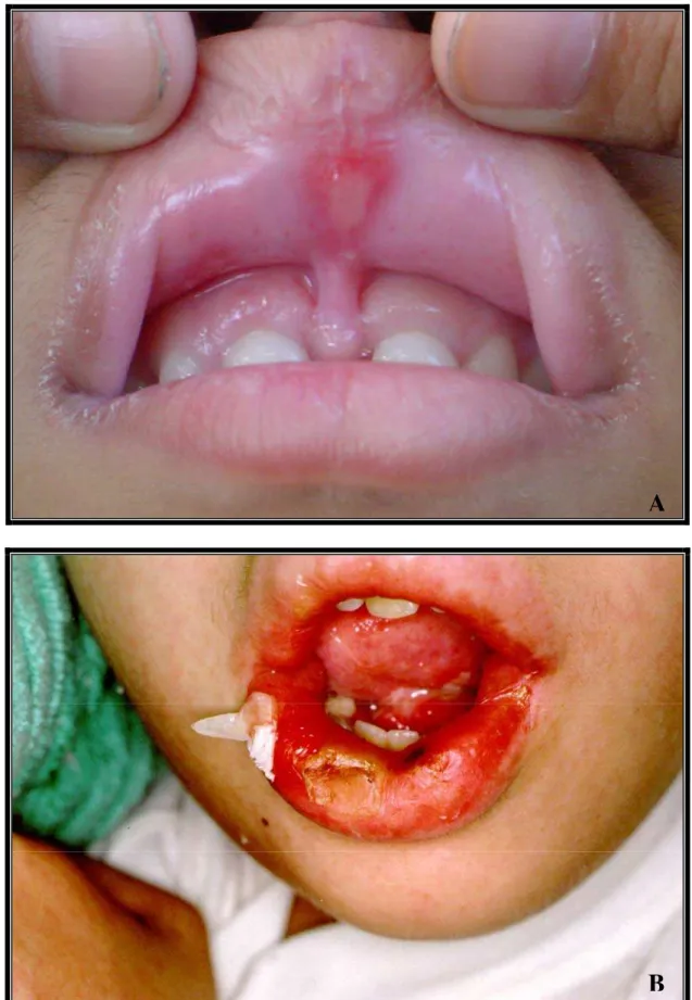 FIGURA 14 – Manifestação da mucosite bucal com lesões discretas no lábio (A) e  lesões mais graves (B) nos pacientes com leucemia linfóide aguda em  tratamento no Hospital Infantil Darcy Vargas em São Paulo
