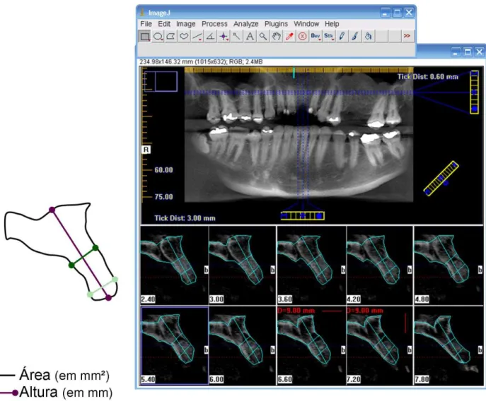Figura  1.  As  áreas  enxertadas  foram  avaliadas  através  de  tomografia  processada  por  I-CAT  Cone  Beam  3-D  Dental  Imaging  System