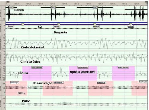 Figura 2. Exemplo de um paciente apresentando apnéia obstrutiva do sono. 
