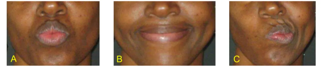 Figura 7 – Movimentos de protrusão (A), estiramento (B) e lateralização (C)  de lábios para a direita e para esquerda, realizados durante a avaliação de  mobilidade de lábios 