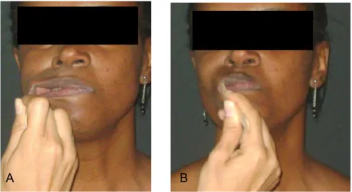 Figura 10 – Avaliação da tonicidade de bochechas. A – tração lateral da  bochecha com espátula; B – resistência de bochecha à tração e protrusão  dos lábios