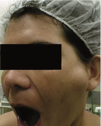 Figura 2. Assimetria facial mais evidente quando da abertura da boca. 