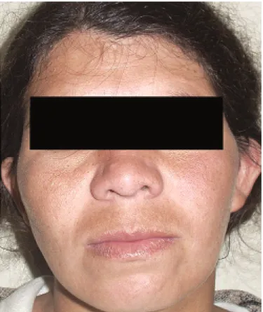 Figura 10. Paciente em pós-operatório tardio com contorno facial preservado. 