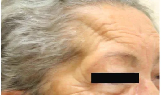 FIGURA 2: Fotografia pós-operatória ilustrando o resultado estético da  craniotomia pterional