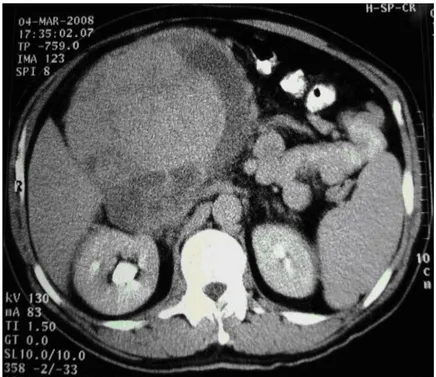 Figura 1 - extensa lesão tumoral justa hepática. 