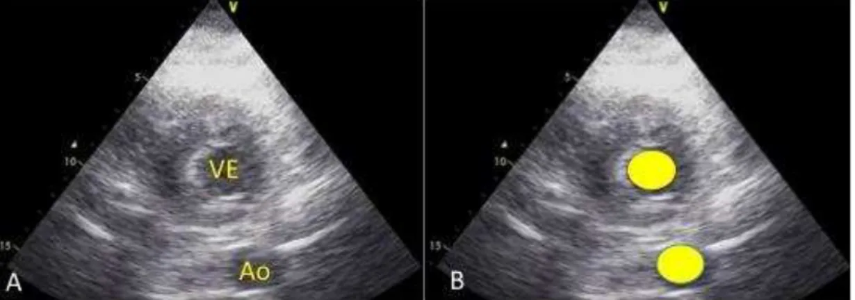 Figura  7  -  A  -  Imagem  paraesternal  transversal  evidenciando  ventrículo  esquerdo com diâmetro reduzido durante diástole  em um situação clínica de  hipovolemia; B - Imagem paraesternal transversal evidenciando diâmetro do  VE  na  diástole  semelh