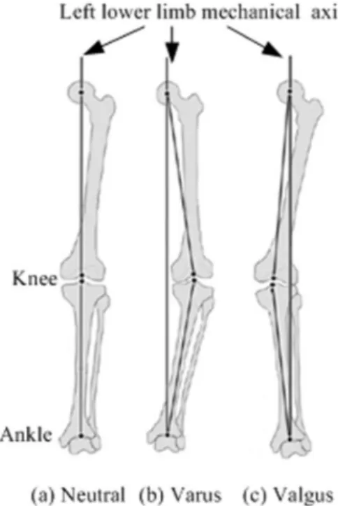 Figure 2.3. Mechanical Axis of the Lower Limb on normal and deformed lower limbs (from [C])