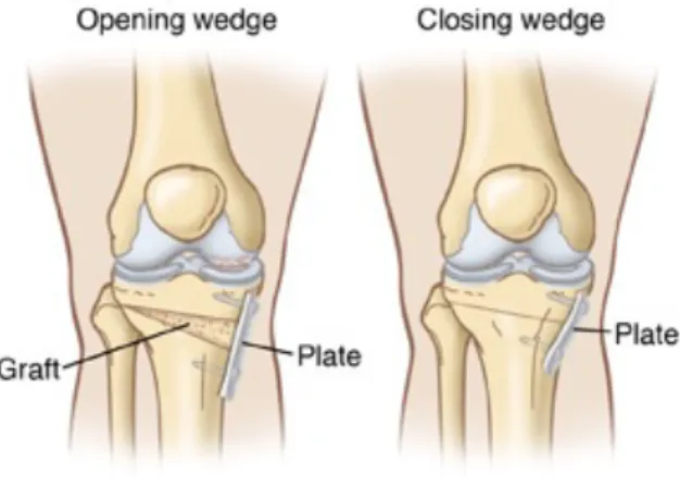 Figure 2.4. Schematics of the results of opening wedge and closing wedge osteotomy (from [D])