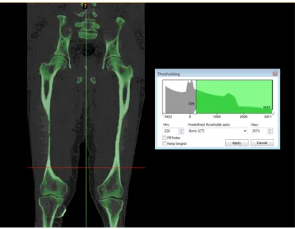 Figure 5.1. Threshold segmentation result on Patient 1 using the dedicated tool and “Bone (CT)” setting in Mimics
