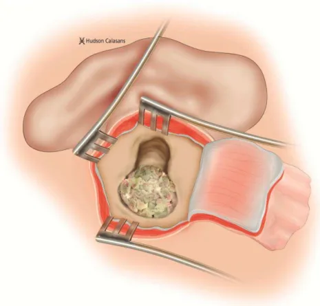 Figura  4  -  Confecção  de  retalho  músculo-periosteal  pediculado  superior  e  exposição da cavidade mastoidea 