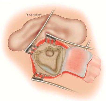 Figura  5  -  Mastoidectomia  cavidade  aberta  com  remoção  completa  da  doença,  rebaixamento  da  parede  posterior  do  conduto  até  o  canal  de  Falópio, exposição do ângulo sino-dural e remoção de células residuais da  mastoide 