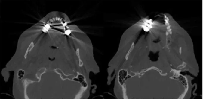 Figure 4. CT slices of a head and neck patient showing metal artifacts.  