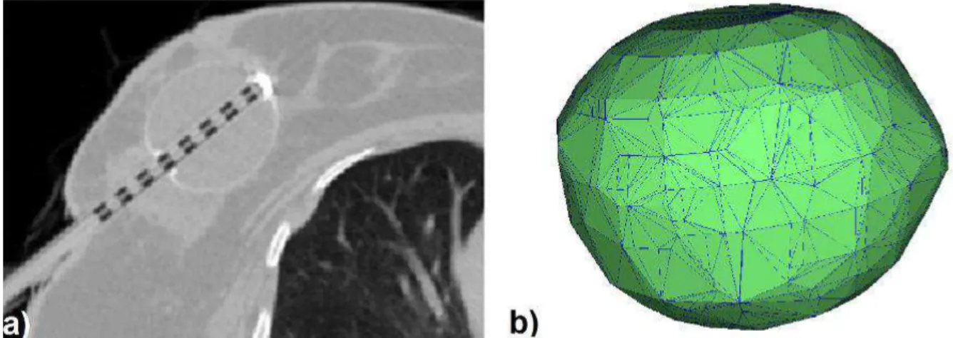 Figure 11. a) Axial CT image of an APBI balloon applicator inserted in a post surgical breast  cavity