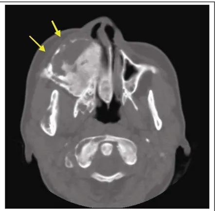 Figura 5.3 - TC em corte axial com janela para tecido ósseo, mostrando uma imagem pagetóide (hiper  e hipodensa) envolvendo a maxila, esfenóide, vômer e mandíbula do lado direito (DFCF)