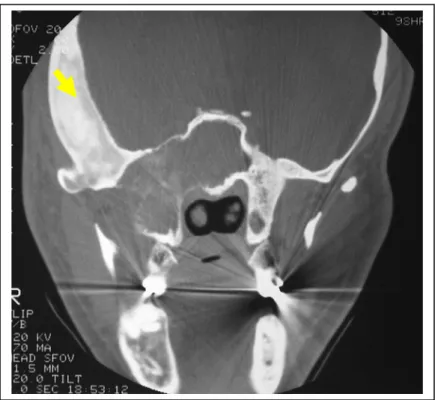 Figura 5.6 – TC em corte coronal com janela para tecido ósseo, mostrando uma imagem esclerótica  afetando o temporal (seta), além de imagem pagetóide afetando o esfenóide e a  mandíbula do lado esquerdo (DFCF)