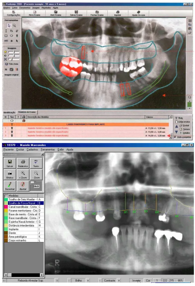 FIGURA 4 - Exemplos de laudos fornecidos por programas de imagem para  planejamento de implantes: I Radioimp e II Planimp 