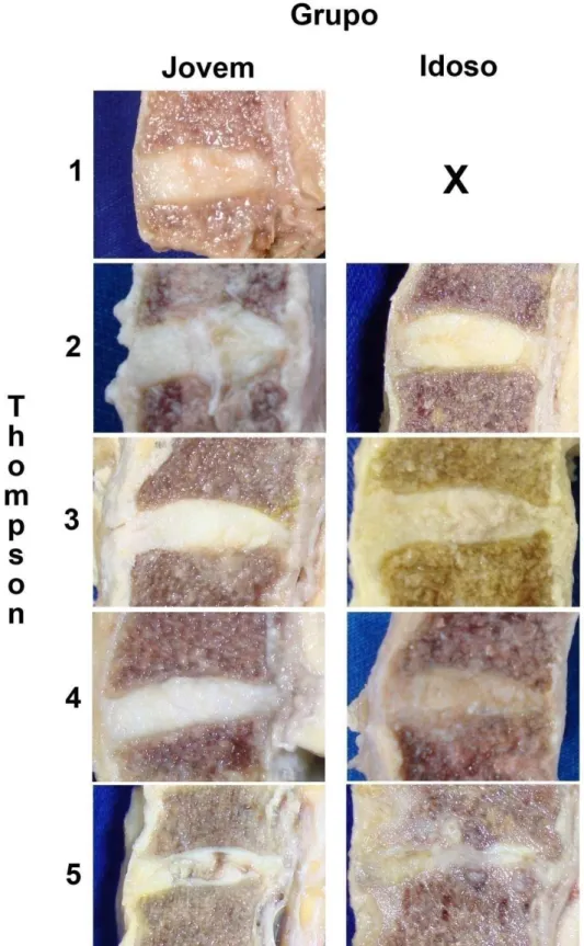 Figura 10 – Segmento cervical – demonstração dos diferentes graus de Thompson em  GJ e GI