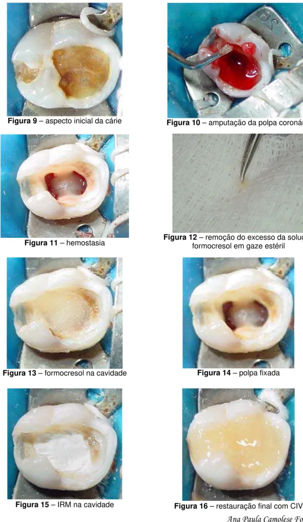 Figura 13 – formocresol na cavidade      Figura 14 – polpa fixada