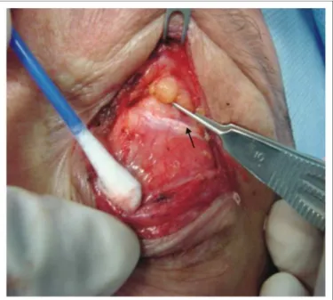 Figura 1 -  Ligamento de Whitnall 