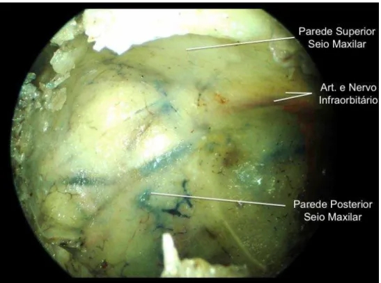 Figura 10 - Visão do seio maxilar com endoscópio de 45 0  após antrostomia maxilar ampla