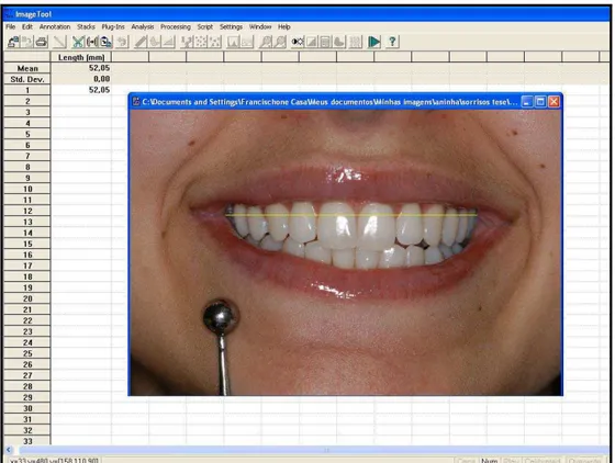 Fig. 4.6 -  Imagem da tela do computador mostrando o método de medida da largura  do sorriso