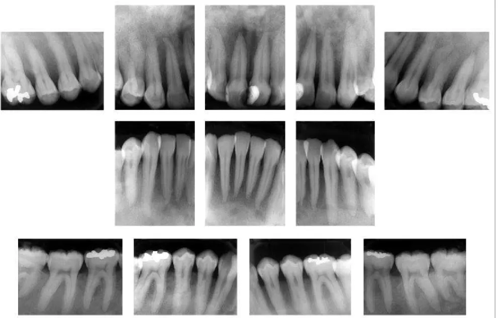 FIGURA 13 - Características radiográficas dentárias e alveolares de paciente com hiperparatireoidismo