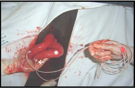 Figura 5 - Fotografia do procedimento cirúrgico de implantação do cateter balonete  intrauterino