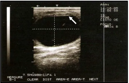 Figura 8 – Imagem ultrassonográfica de um cisto folicular. Observar (seta) a  espessura da parede do cisto