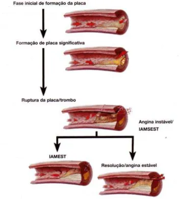 Figura 4 – Fisiopatologia das Síndromes Coronarianas Agudas. 