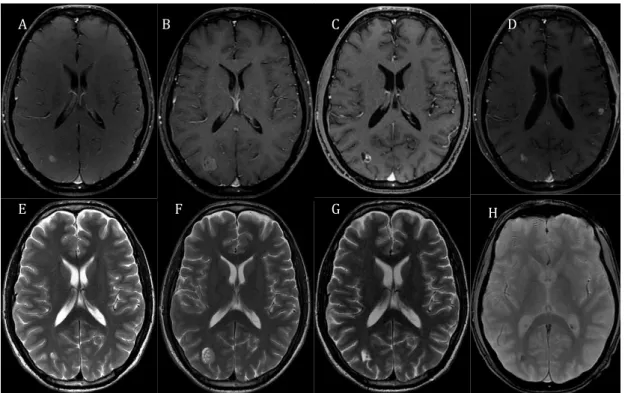Figura 3  Evolução por imagem de metástase cerebral tratada por radiocirurgia. 