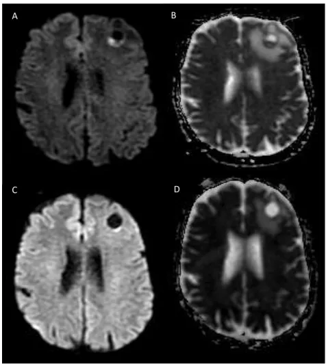 Figura 4.  Metástase cerebral com boa resposta terapêutica após radicocirurgia. 