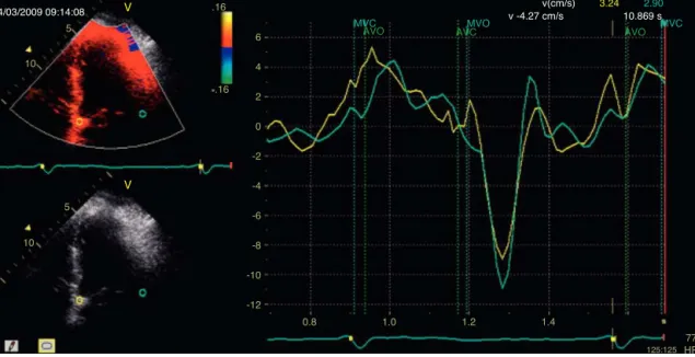 Figure 1 Normal early diastolic mitral annular velocity (E’) supporting a diagnosis of constrictive pericarditis.