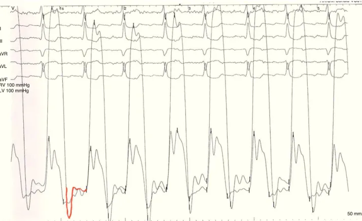 Figure 3 Ventricular pressures with left ventricular dip-and-plateau pattern.