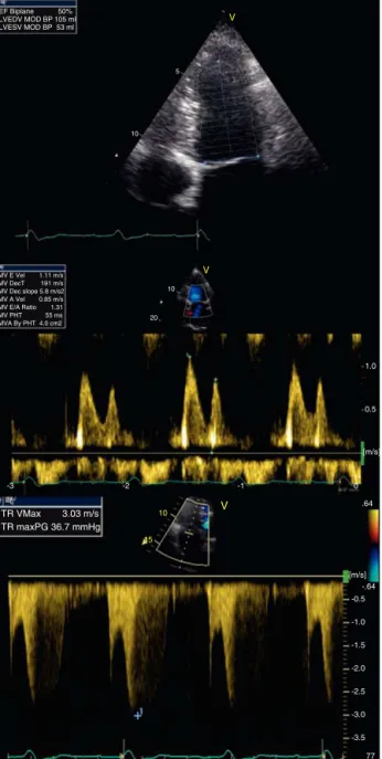 Figure 5 Postoperative echocardiography. Top: left ventri- ventri-cular ejection fraction (50% by Simpson’s biplane method);