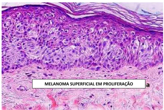 Figura 2: Micrografia de luz mostrando um tumor primário superficial de melanoma. 